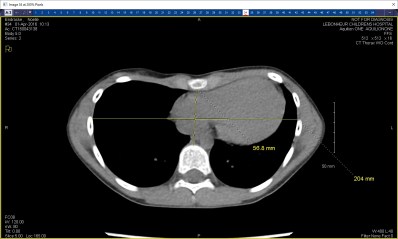 Noelle's CT scan April 1 2016