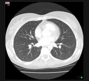 Normal Chest CT
